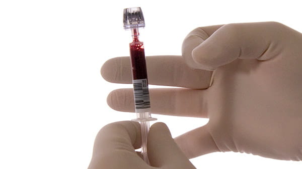 Aライン採血用の血液ガスシリンジ safePICO Aspirator