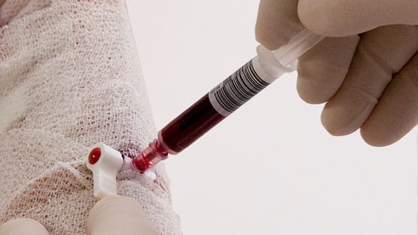 Aライン採血用の血液ガスシリンジ safePICO Aspirator