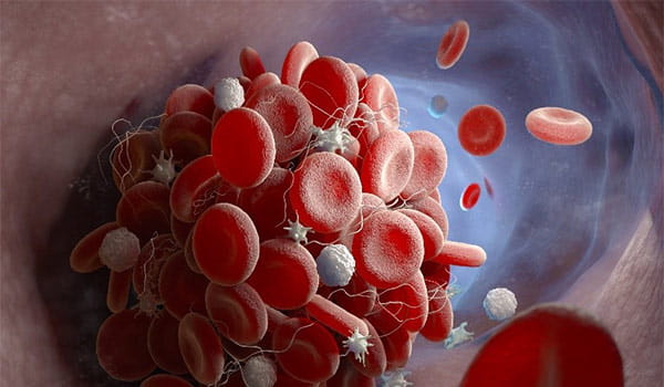 深部静脈血栓症(DVT)